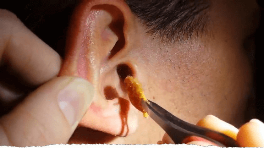 Co to jest woskowina w uchu?